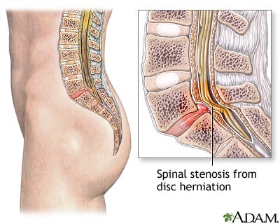 herniation of brain. continuous downward spiral